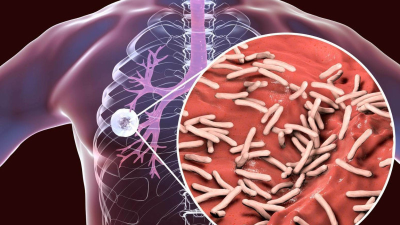 TÜBERKÜLOZ BELİRTİLERİNE DİKKAT ÇEKİLDİ